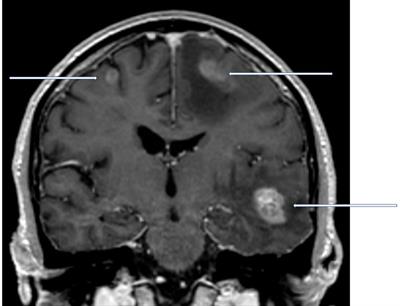 Personalized treatment of brain metastases: Evolving survival prediction models may benefit from evaluation of serum tumor markers (narrative review)